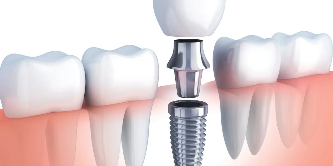 Comprehensive Dental Implant Solutions: A Lifelong Investment in Your Smile